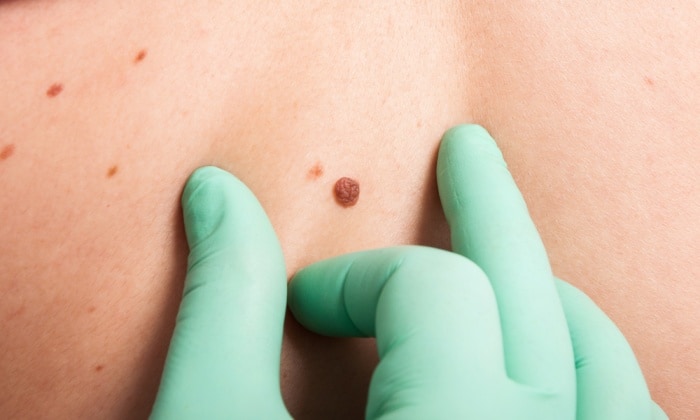 ไฝ แบบใดเป็น สัญญาณของมะเร็งผิวหนัง