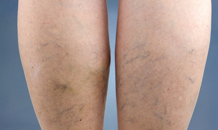 เส้นเลือดขอด กับ วิธีรักษา ที่สามารถทำเองได้ที่บ้าน