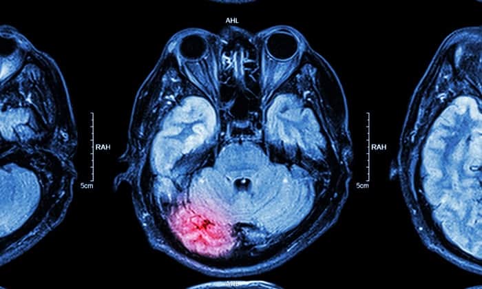 อาการบาดเจ็บที่สมอง ส่งผลเสียอย่างไรต่อตัวคุณบ้าง