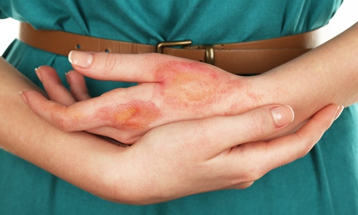 ดูแลแผลไฟไหม้ อย่างไรถึงจะปลอดภัยที่สุด