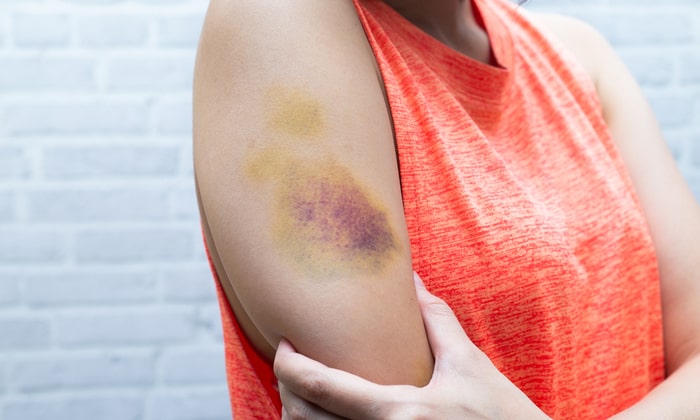 ช้ำรักยังพอทน แต่ผิวมี รอยฟกช้ำ ฉันทนไม่ได้