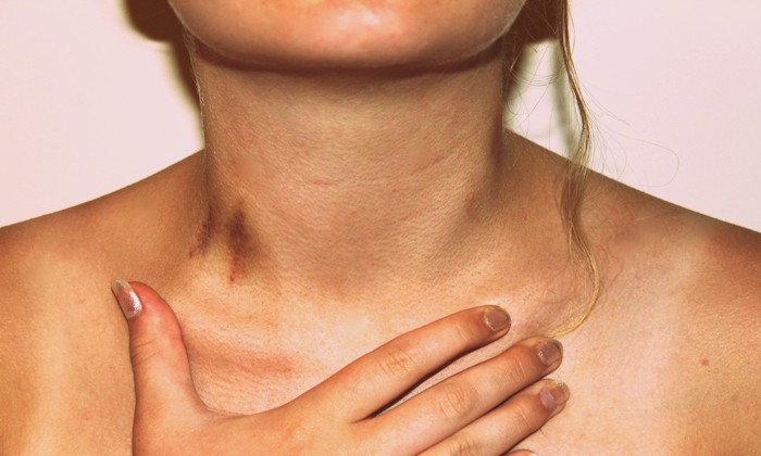 7 วิธีลบ รอยจูบ รอยจ้ำ ให้หายไปอย่างรวดเร็ว