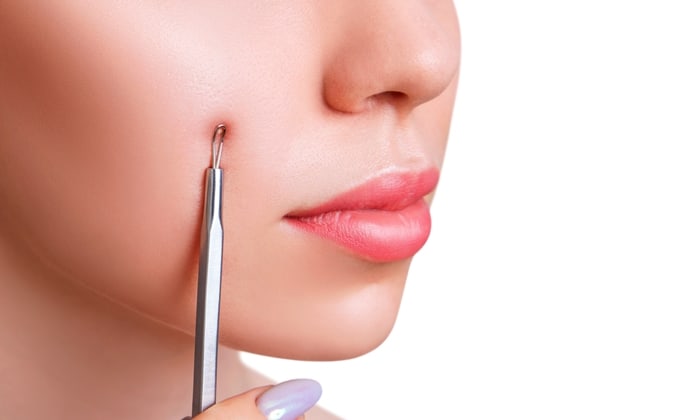 วิธีกดสิวที่ถูกต้อง ปลอดภัย หากจำเป็นต้องกำจัดสิวแบบเร่งด่วน