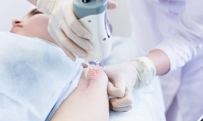 เรื่องน่ารู้ของ เลเซอร์กำจัดแผลเป็น เทคนิคลบรอยแผลให้แลดูจางลงอย่างรวดเร็ว