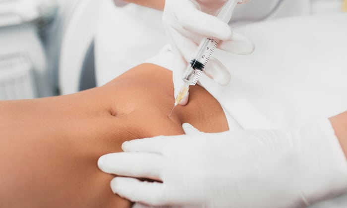 เมโสเธอราพี (Mesotherapy) อีกหนึ่งทางเลือกในการกำจัดไขมัน