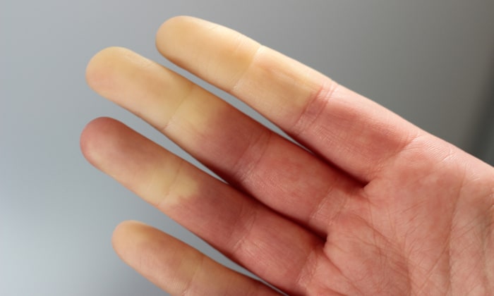 ภาวะมือชา สัญญาณเตือนของ โรคเรเนาด์ ที่กำลังคุกคามร่างกายคุณ