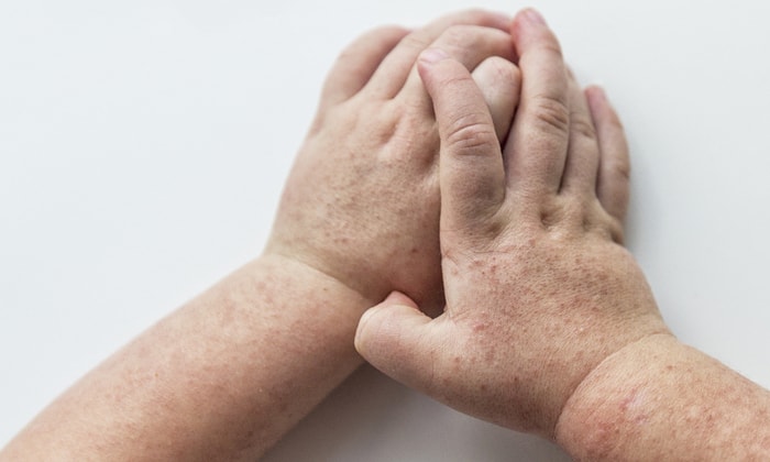 scarlet fever คือ ไข้อีดำอีแดงจากเชื้อแบคทีเรียที่มักเกิดขึ้นในเด็ก