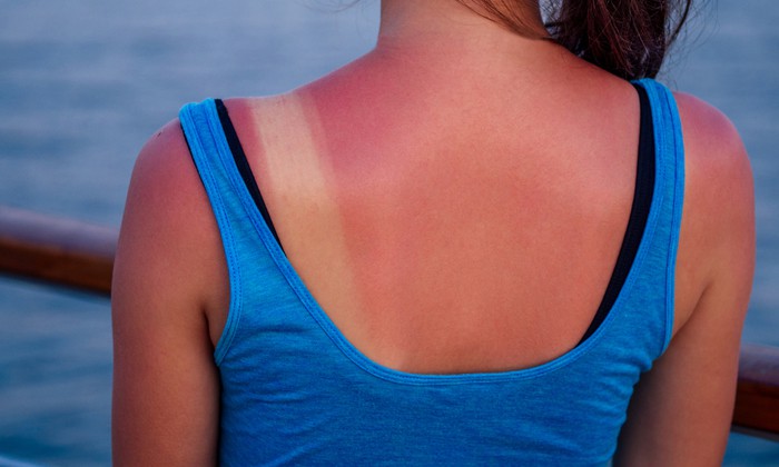 อาการแพ้แดด อันตรายจากแสงอาทิตย์ที่ใครหลายคนควรระวัง