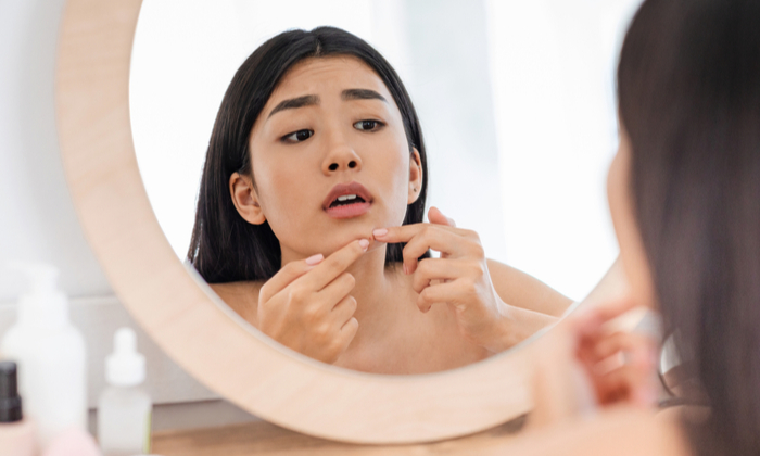 สิวที่สันกราม สาเหตุ การรักษา และการป้องกัน