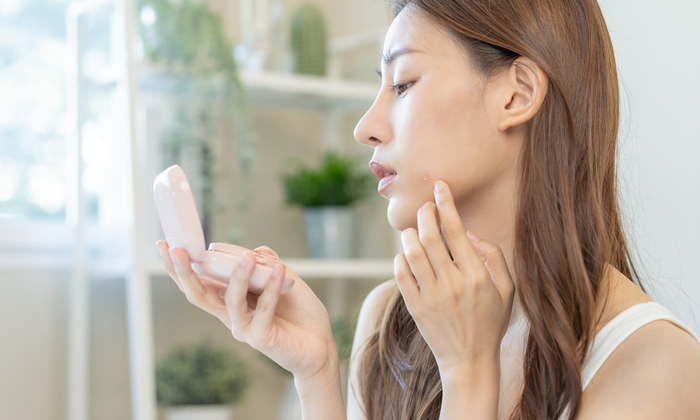 วิธีการรักษาให้ สิวหาย หน้าใส ทำได้อย่างไร