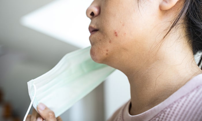 เป็นสิวเพราะสวมหน้ากากอนามัย ดูแลได้อย่างไรบ้าง