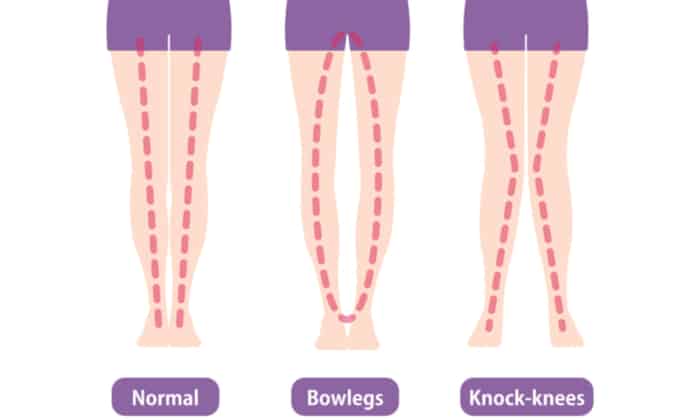 ขาโก่ง ในเด็กใช่สัญญาณสะท้อนปัญหาสุขภาพกระดูกหรือไม่