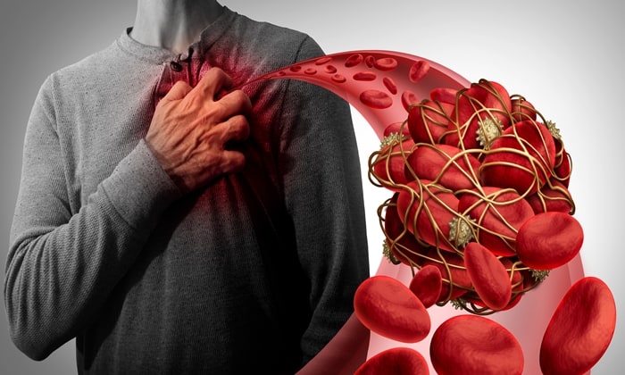 ลิ่มเลือดอุดตัน อีกหนึ่งภาวะแทรกซ้อนจากโควิด-19 ที่อาจอันตรายถึงตาย