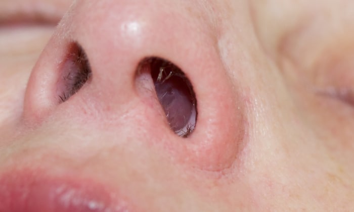 เช็กด่วน! 6 อาการเสี่ยงสัญญาณเตือน ริดสีดวงจมูก