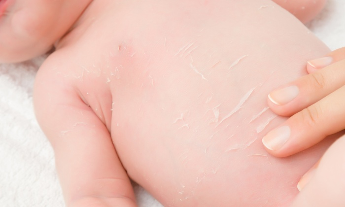 ไข้ออกผื่น ลูกไม่สบายทีไร ผื่นขึ้นทุกครั้ง