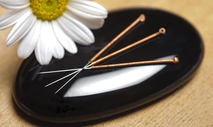 การรักษาโรคด้วยการฝังเข็ม กับประโยชน์ต่างๆ ที่คุณควรรู้