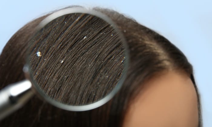 สาเหตุที่ทำให้ลูกมีรังแค และวิธีการรักษา