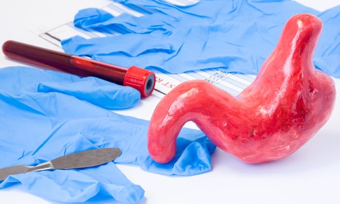 ผ่าตัดกระเพาะอาหาร (Gastric Sleeve Surgery)