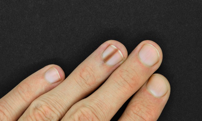 เล็บเป็นขีดสีดํา เล็กๆ สัญญาณเตือนโรคที่ไม่ควรมองข้าม