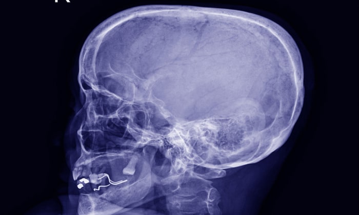 แพทย์เผย! ปิดปาก-ปิดจมูก ขณะจาม อาจเสี่ยง โรคลมเข้าสมอง