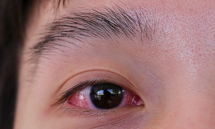 อาการตาแดงกับเชื้อไวรัสโคโรนา มีความเกี่ยวข้องกันอย่างไร