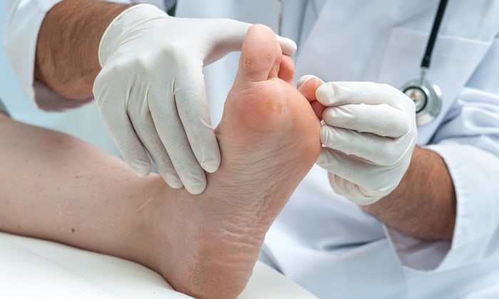 โรคน้ำกัดเท้า หรือโรคฮ่องกงฟุต อาการ ปัจจัยเสี่ยง วิธีรักษา