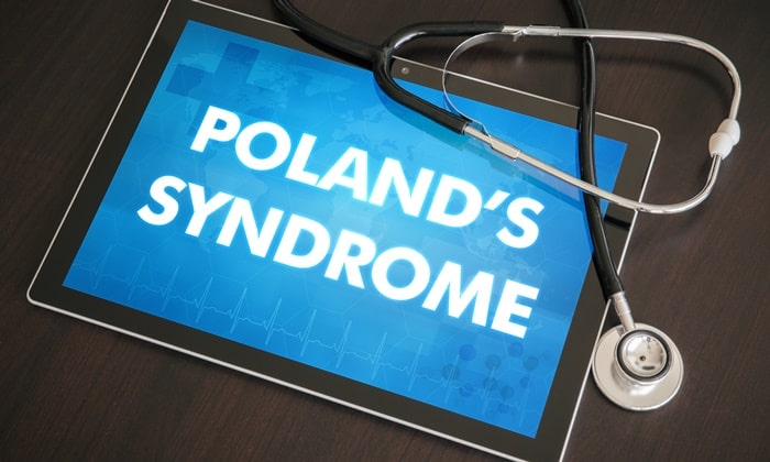 โปแลนด์ซินโดรม อาการ สาเหตุ วิธีรักษา