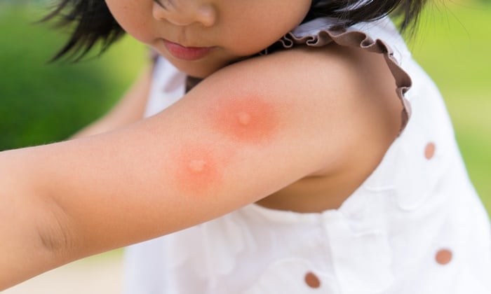 ป้องกันลูกน้อยจากยุง ตัวร้ายแสนกวนใจ มีวิธีไหนบ้าง