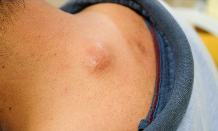 ซีสต์ไขมันใต้ผิวหนัง สาเหตุ อาการ และการรักษา