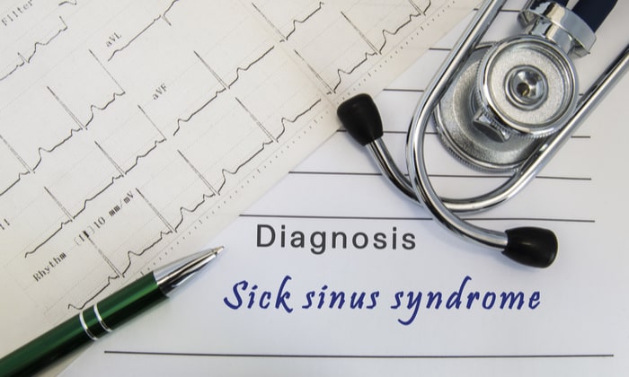 กลุ่มอาการซิคไซนัส (Sick Sinus Syndrome : SSS)