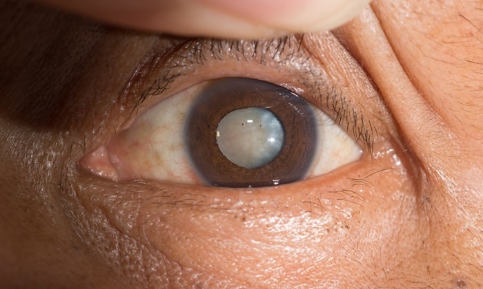 สัญญาณเตือนของดวงตา ที่เป็นสัญญาณของการเกิด โรคต้อกระจก