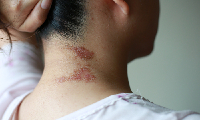 อันตรายจากพิษของแมลงก้นกระดก และวิธีการรักษา