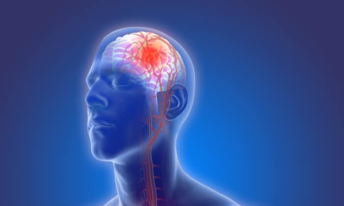 โรคหลอดเลือดสมองผิดปกติเอวีเอ็ม (Cerebral arteriovenous malformation)