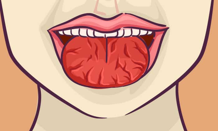 ลิ้นแตกเป็นร่อง (Fissured Tongue)