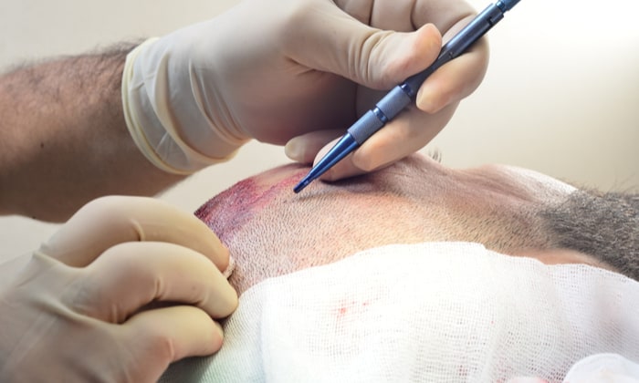 ปลูกผม มีกี่วิธี พร้อมผลข้างเคียงและวิธีดูแลหลังปลูกผม