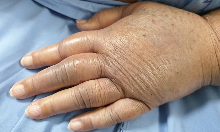 ภาวะน้ำเกิน (Hypervolemia)