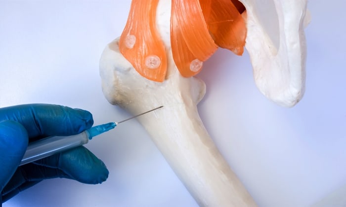 พังผืดในไขกระดูก (Myelofibrosis)