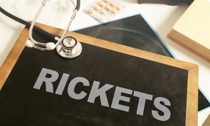 โรคกระดูกอ่อนในเด็ก อาการ สาเหตุ และการรักษา