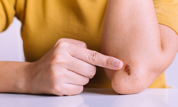 แผลตกสะเก็ด เมื่อไหร่..ทำไมถึงทำให้เรารู้สึกคันแผลทุกทีนะ