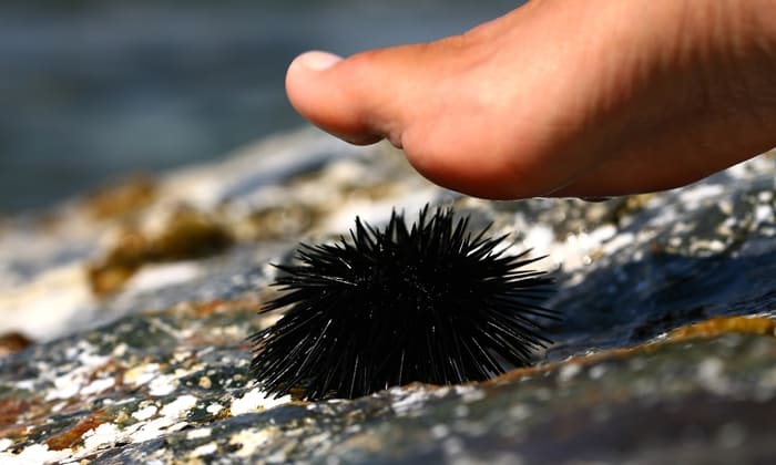 วิธีปฐมพยาบาลเบื้องต้น เมื่อถูก หอยเม่น ตำเท้า