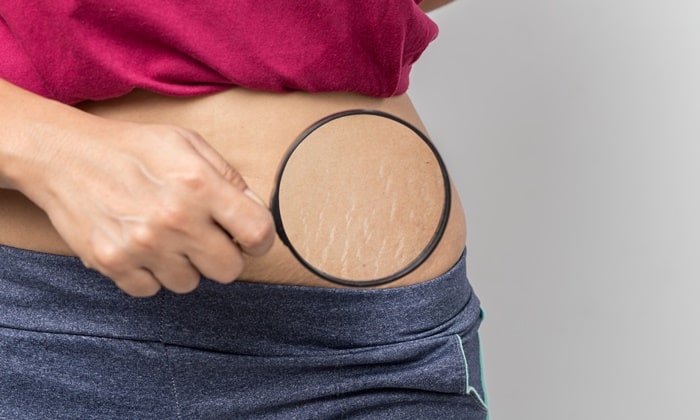 วิธีการรักษาและการป้องกัน ปัญหาผิวแตกลาย