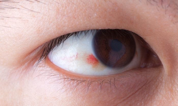 เส้นเลือดฝอยในดวงตาแตก (Subconjunctival Hemorrhage)