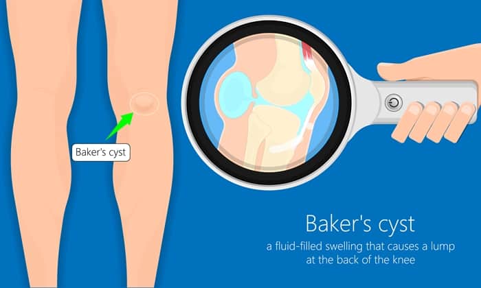 ภาวะถุงน้ำหลังหัวเข่า (Baker's Cyst)