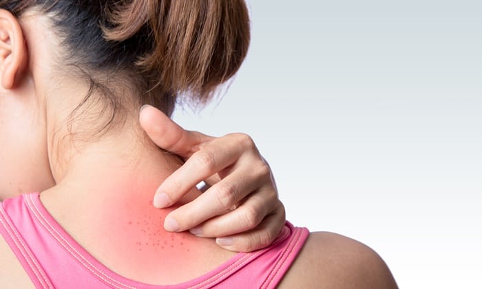 ผื่นผิวหนังในช่วงฤดูร้อน ควรดูแลอย่างไรไม่ให้ลุกลาม