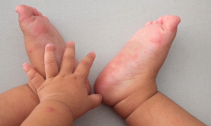 มือเท้าปาก (Hand Foot And Mouth Disease)