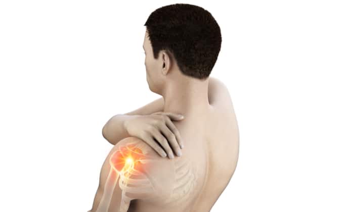 กระดูกงอกทับเอ็นข้อไหล่ (Impingement Syndrome)