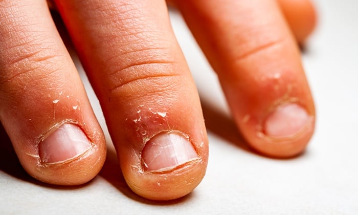 กัดเล็บบ่อยๆ อาจส่งผลเสียต่อสุขภาพได้