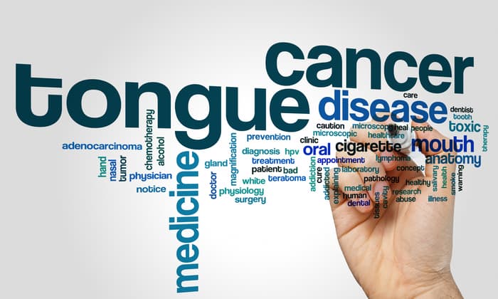 มะเร็งลิ้น (Tongue cancer)