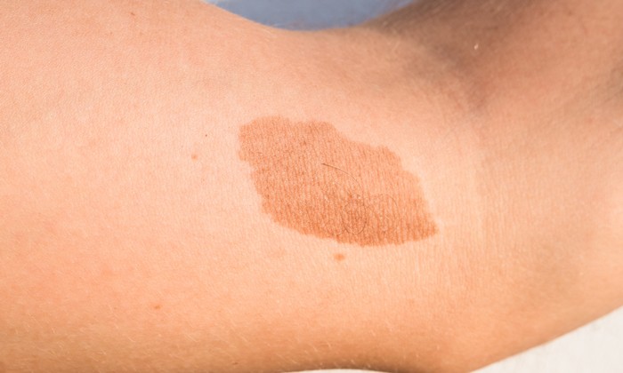 ปานแดง ปานดำ มีความแตกต่างกันอย่างไร