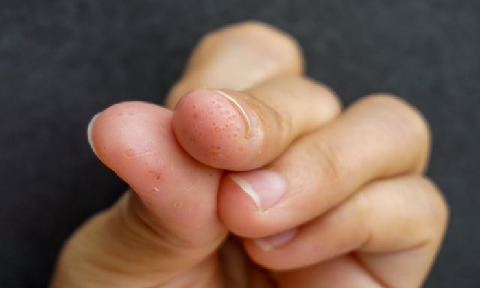 ผื่นผิวหนังอักเสบชนิดตุ่มใส สาเหตุ อาการ และการรักษา